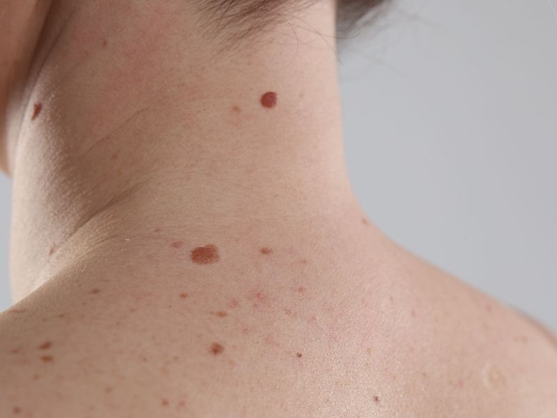 acik-cilt-rengine-sahip-kisilerde-ben