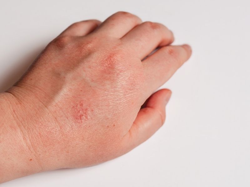 cilt-lezyonlari-belirtileri-nelerdir