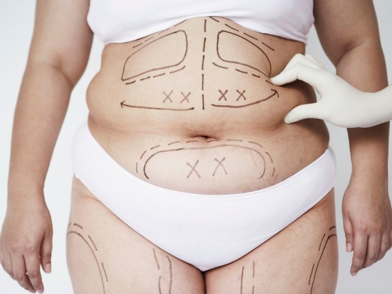 liposuction-yapilan-bolgeler