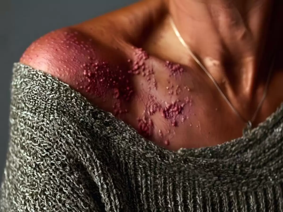 iyi-huylu-cilt-lezyonlari