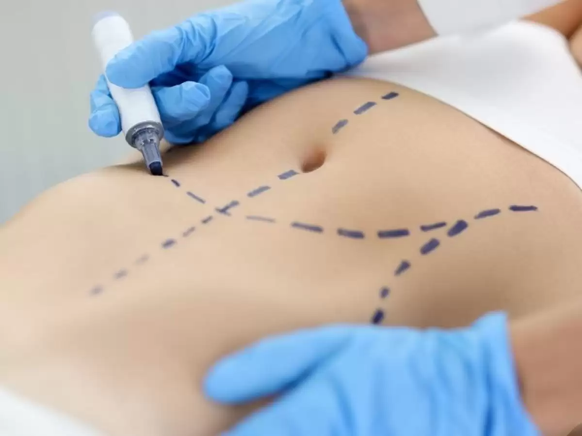 karin-germe-abdominoplasti