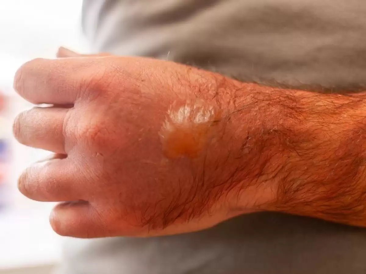 yanik-kasilmalarinin-acilmasi