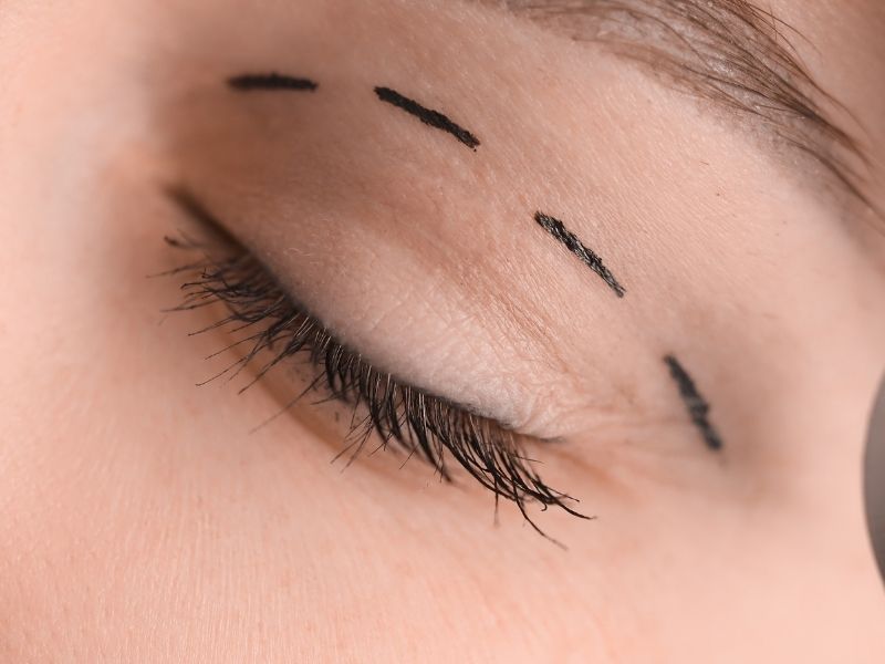 ust-goz-kapagi-ameliyati-kac-gun-dayanir