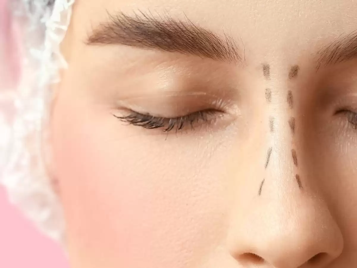 kapali-burun-estetigi-nedir